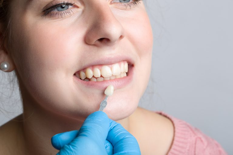 Veneers » Kosten, Preisbeispiele, Spartipps und mehr