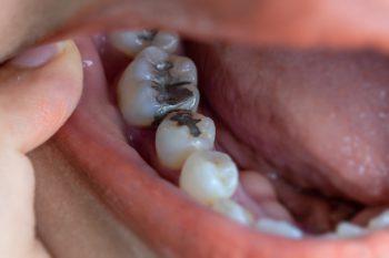 Zahnfullung Kostenfaktoren Preisbeispiele Und Mehr