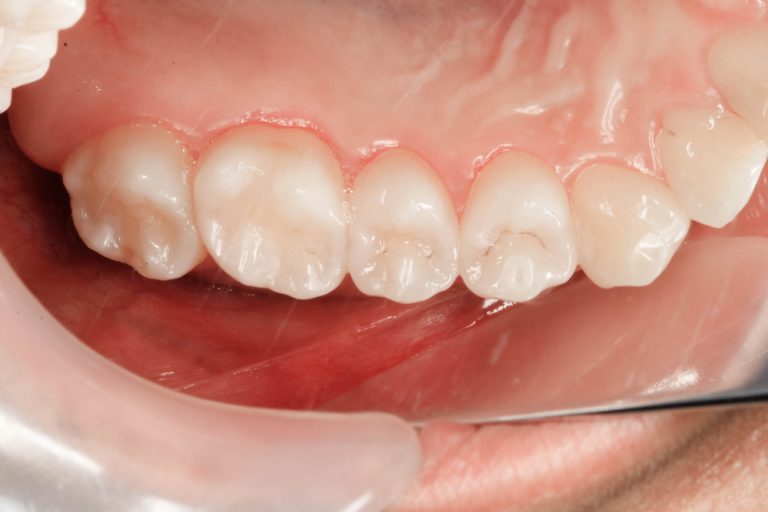 Kunststofffüllung » Kosten, Preisbeispiele und mehr