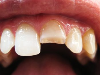 Zahn Abgebrochen Mit Diesen Kosten Konnen Sie Rechnen