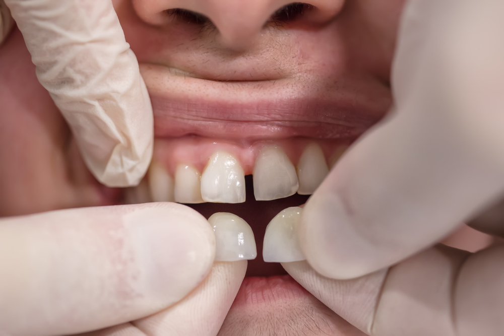Was kostet es, eine Zahnlücke schließen zu lassen?