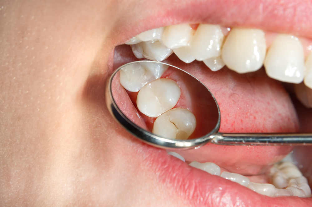 Prophylaxe beim Zahnarzt: Was kostet die Zahnversiegelung?