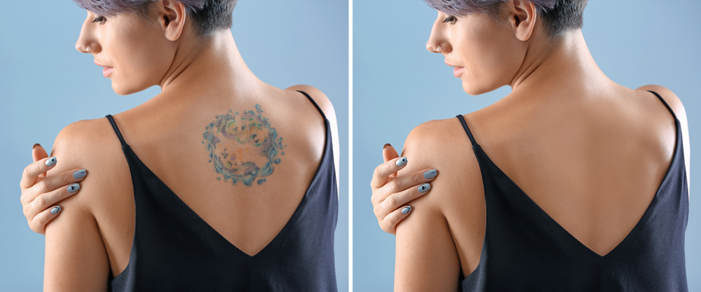 Tattoo lasern » Diese Kosten fallen beim Entfernen an