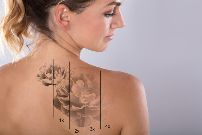 Tattoo lasern » Diese Kosten fallen beim Entfernen an