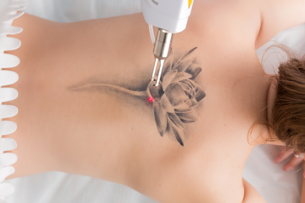 Was kostet es, ein Tattoo lasern zu lassen