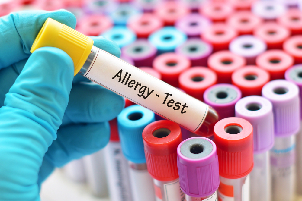 Allergisch oder nicht: Was kostet ein Allergietest?