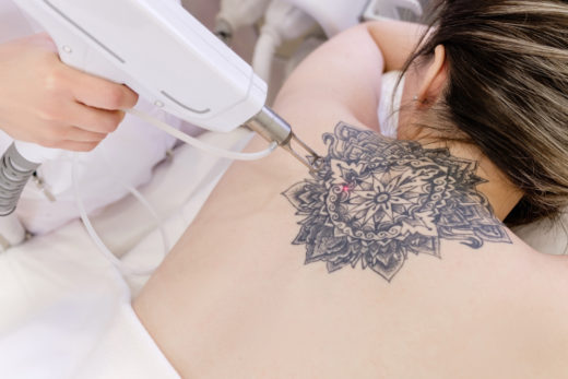tattooentfernung-kosten