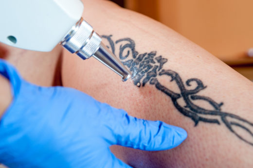 tattooentfernung-kosten